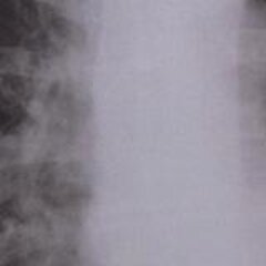 Wilhelm Conrad Röntgen – X-rays travel around the world